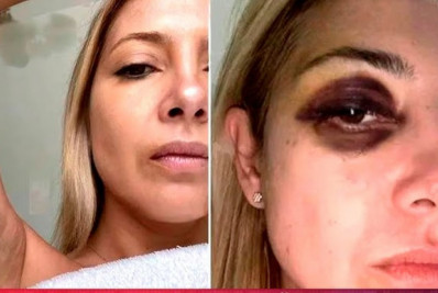 Fernández diz a site que olho roxo em ex-mulher é tratamento cosmético contra ruga