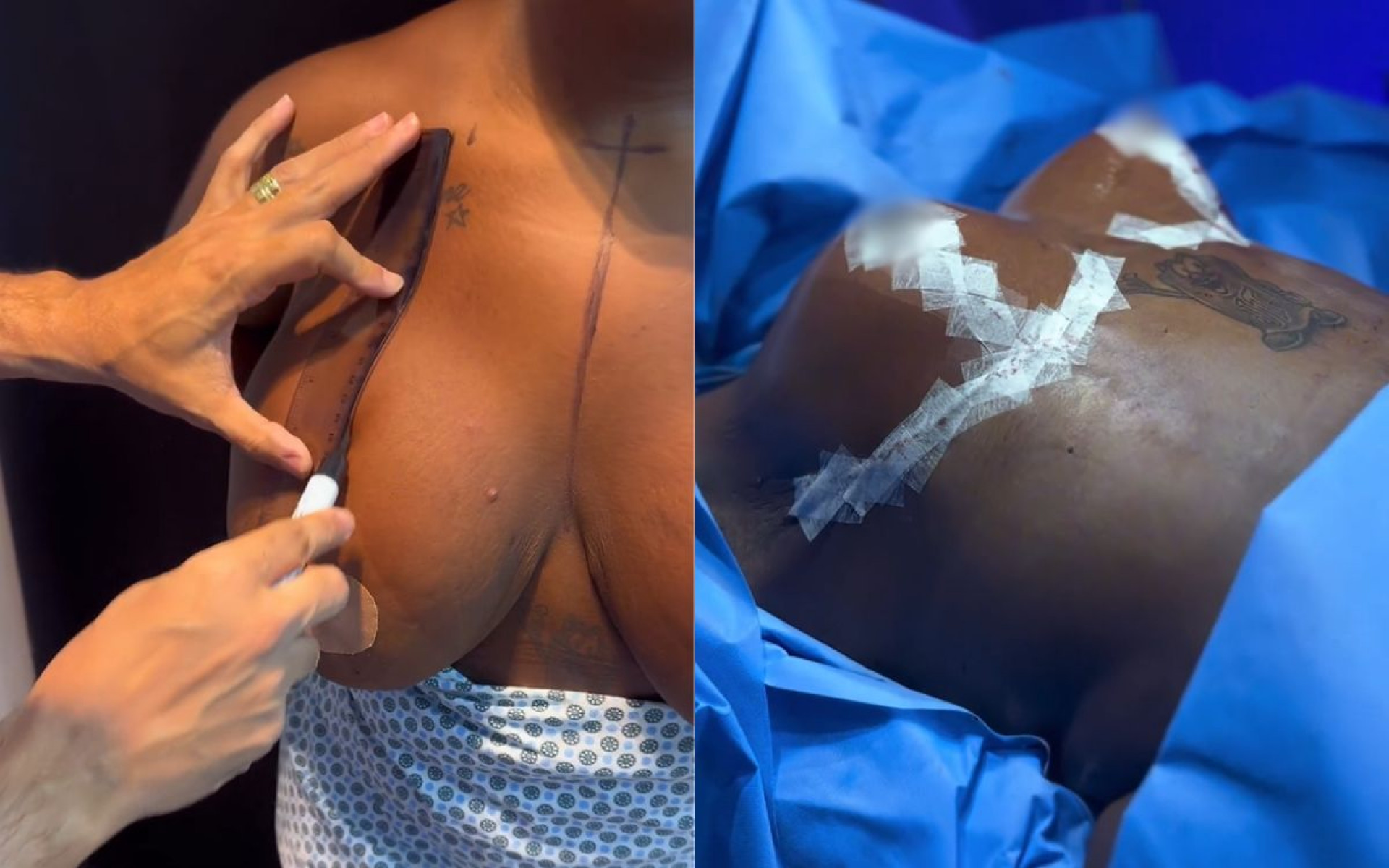 Jojo Todynho mostra cirurgia de redução de mamas - Reprodução / Instagram