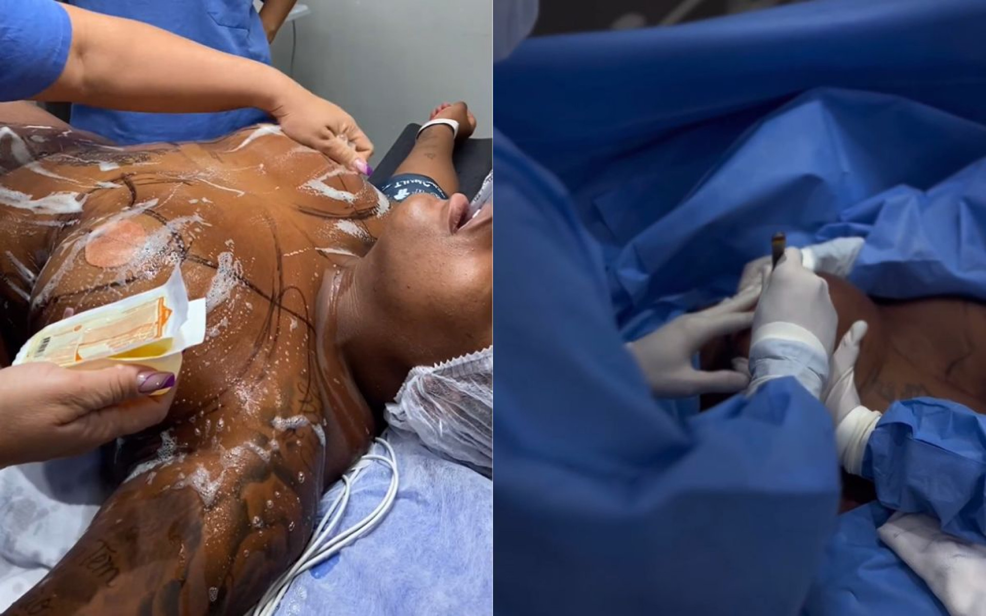 Jojo Todynho mostra cirurgia de redução de mamas - Reprodução / Instagram