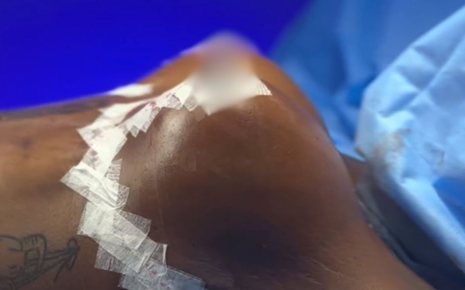 Jojo Todynho mostra cirurgia de redução de mamas - Reprodução / Instagram