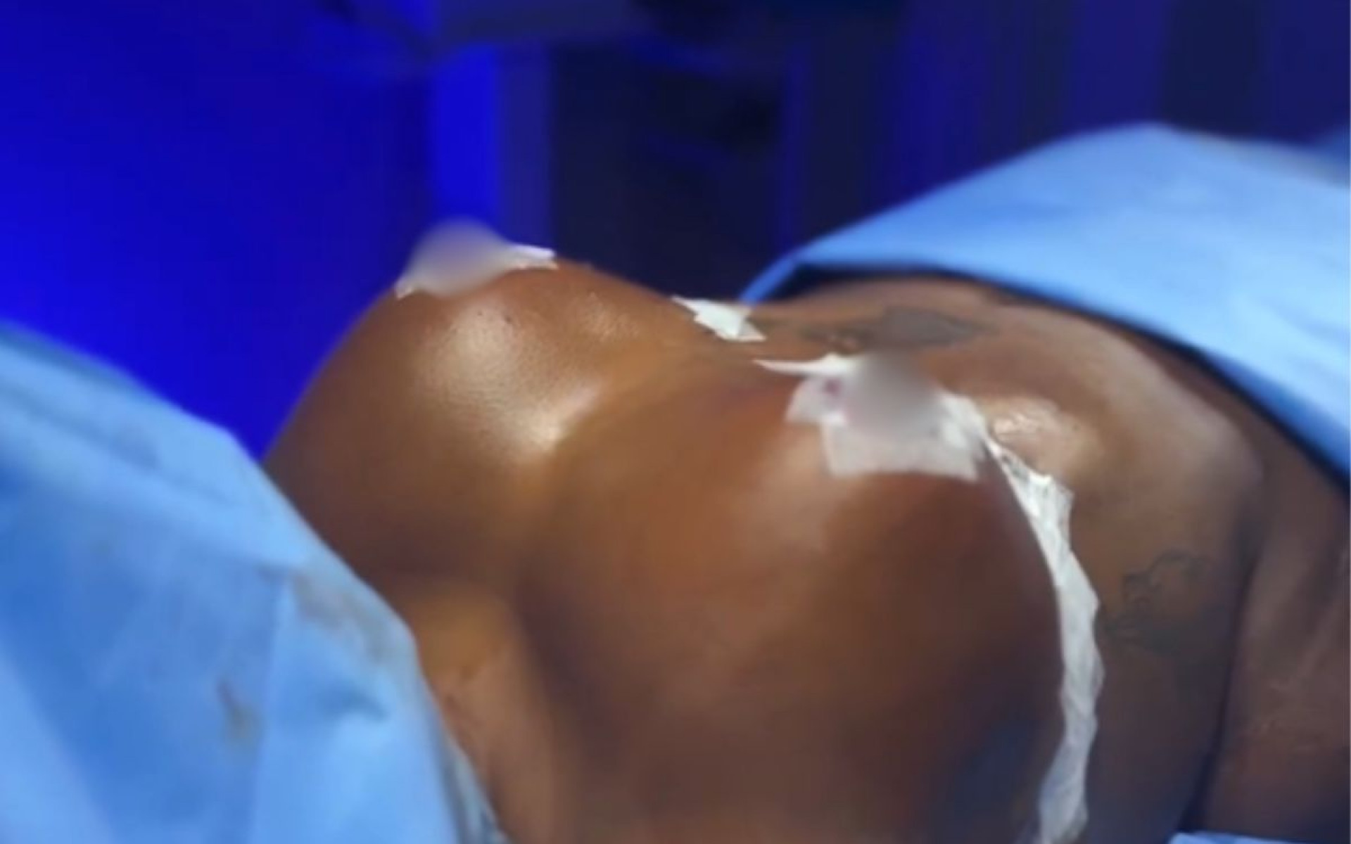 Jojo Todynho mostra cirurgia de redução de mamas - Reprodução / Instagram