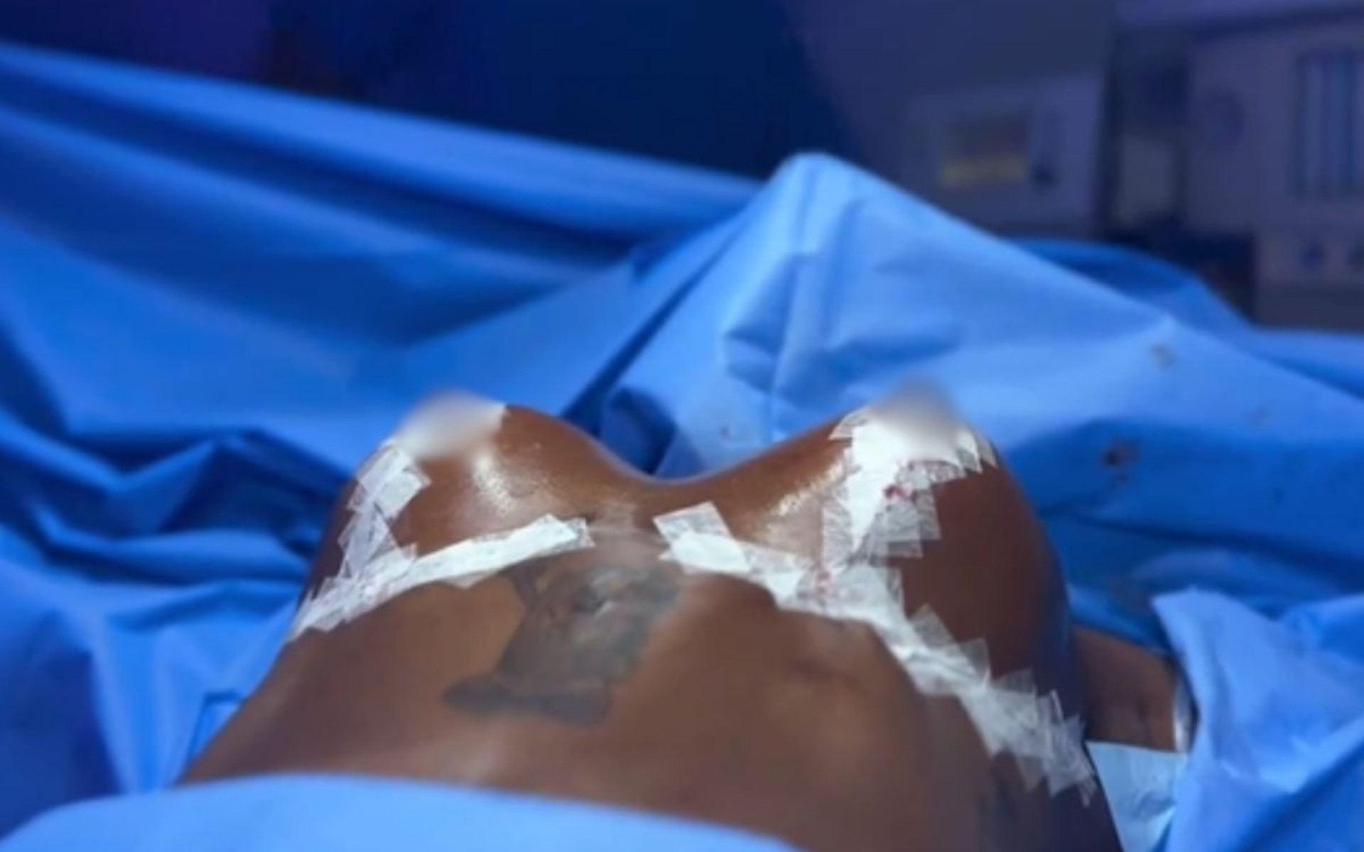 Jojo Todynho mostra cirurgia de redução de mamas - Reprodução / Instagram