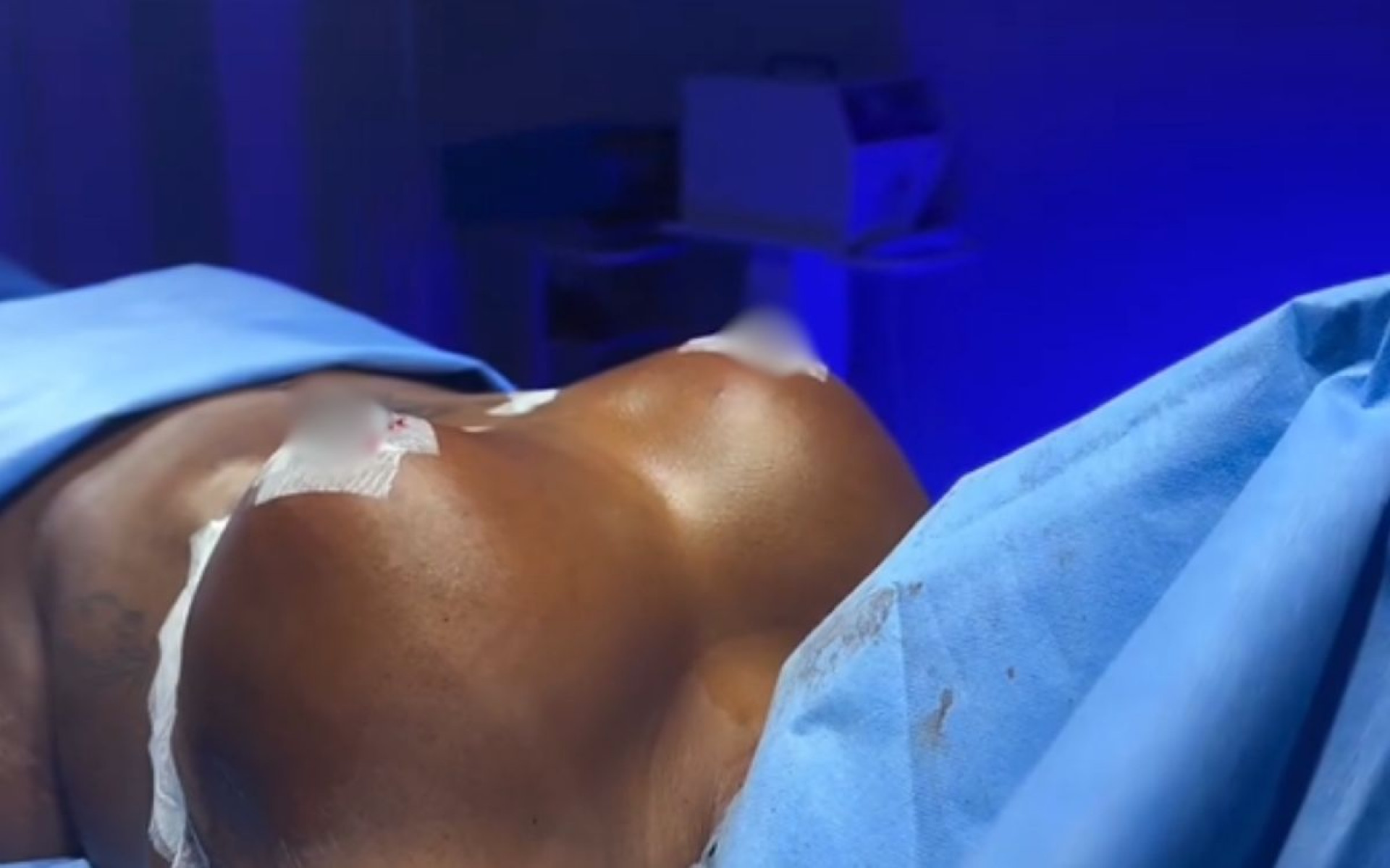 Jojo Todynho mostra cirurgia de redução de mamas - Reprodução / Instagram