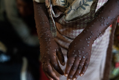 África tem quase quatro mil novos casos de mpox em uma semana, mas ainda não recebeu vacinas