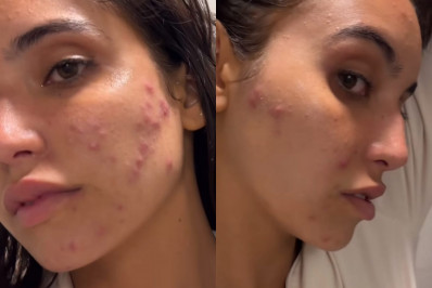 Influenciadora Vanessa Lopes desabafa sobre rosto com espinhas: 'Afeta a minha autoestima'