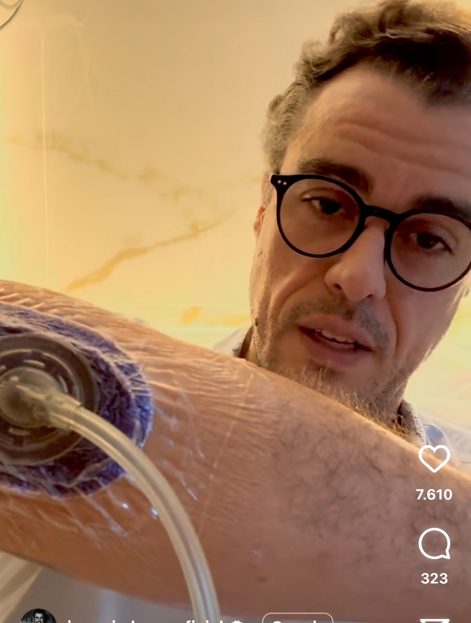 Joaquim  Lopez mostra o procedimento cirúrgico que precisou fazer - Reprodução /Instagram