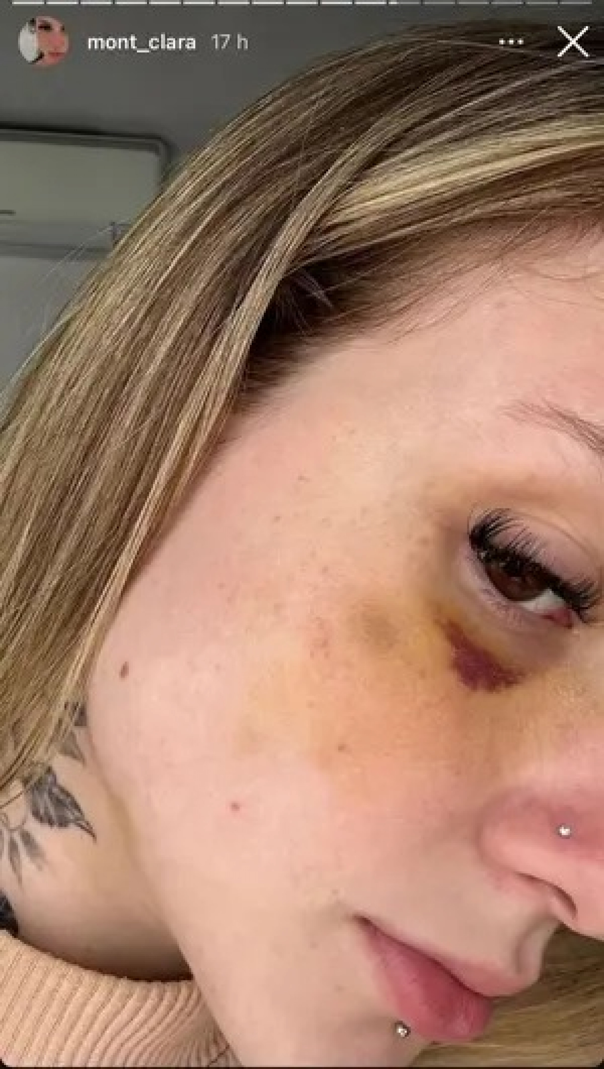 Clara Monteiro mostra hematoma no rosto - Reprodução/Instagram @mont_clara