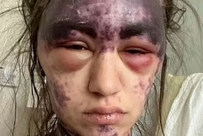 Imagem forte! Mulher fica cega e com hematomas após overdose de vacina