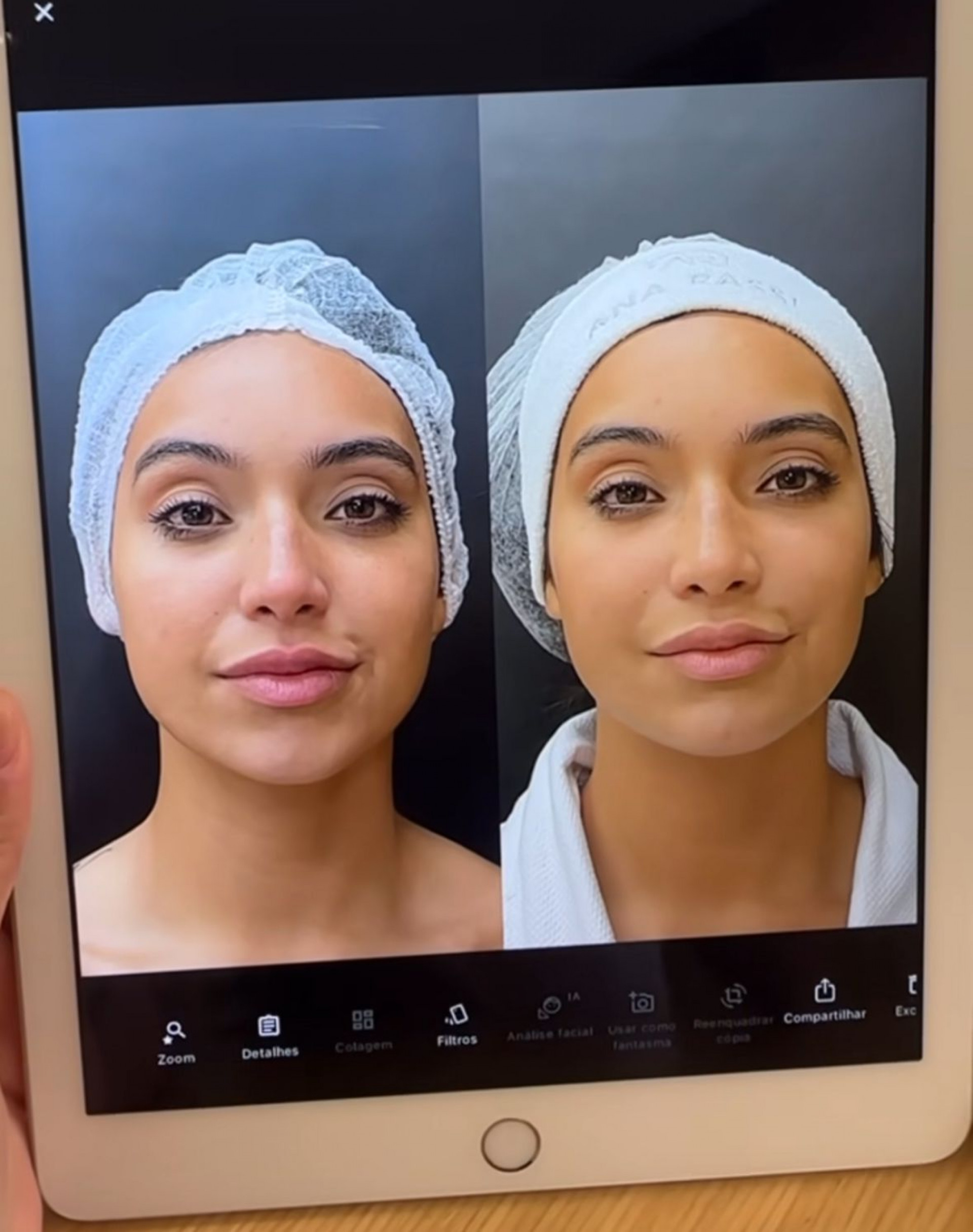 Após realizar alguns procedimentos, ela mostrou registros de antes e depois e listou alguns deles. - Reprodução / Instagram