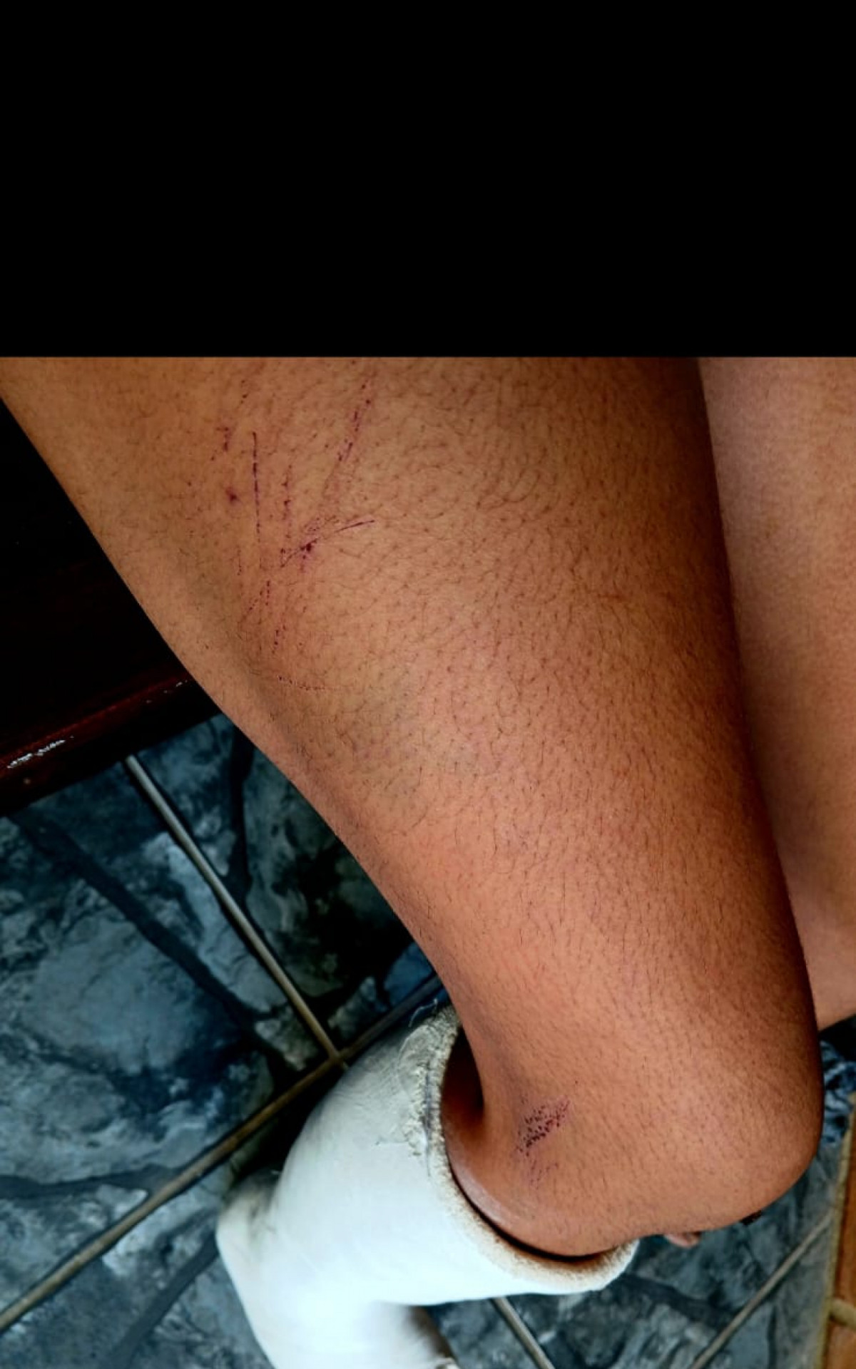 Patrícia Muniz ficou com hematomas no pescoço, no rosto, nas costas e quebrou o pé