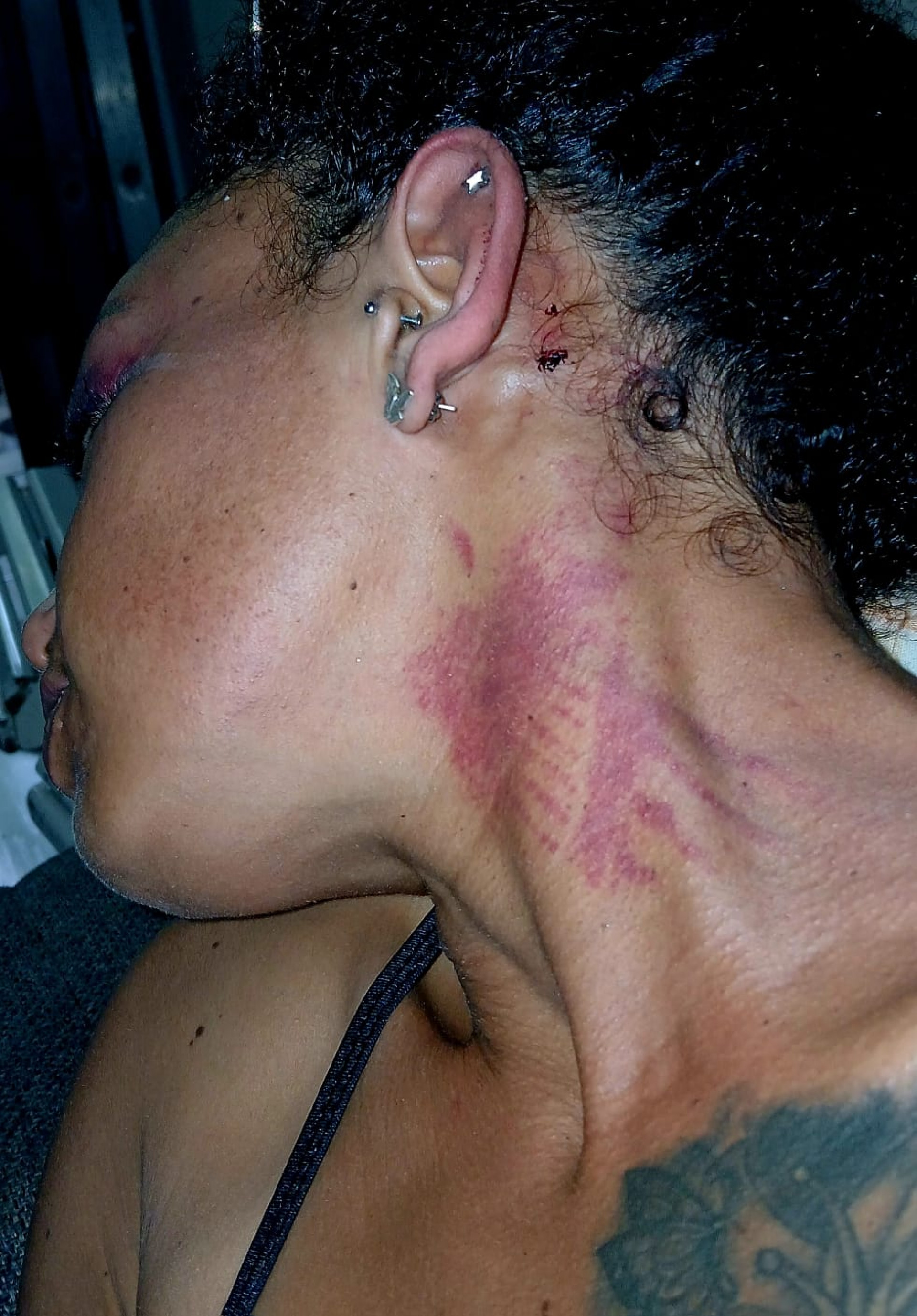 Patrícia Muniz ficou com hematomas no pescoço, no rosto, nas costas e quebrou o pé