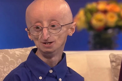 Progeria, a doença do envelhecimento precoce, tem cura? Conheça o quadro