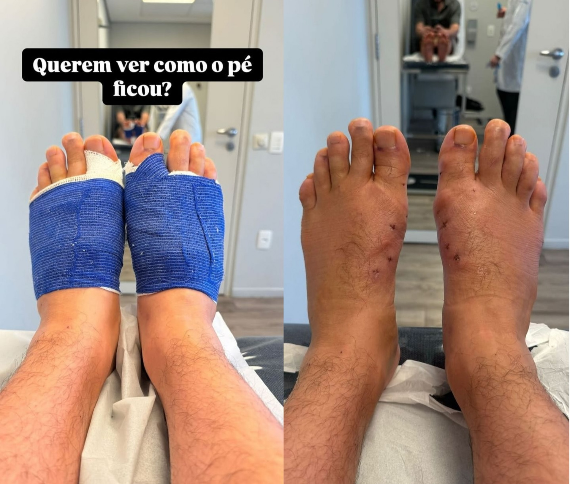 Eliezer compartilhou resultado da cirurgia de retirada dos joanetes - Reprodução/Instagram