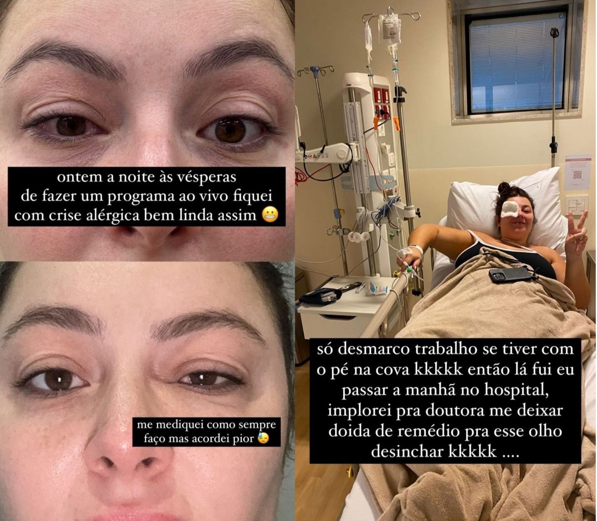 Olho da modelo ficou inchado após uma crise alérgica  - Reprodução/Instagram