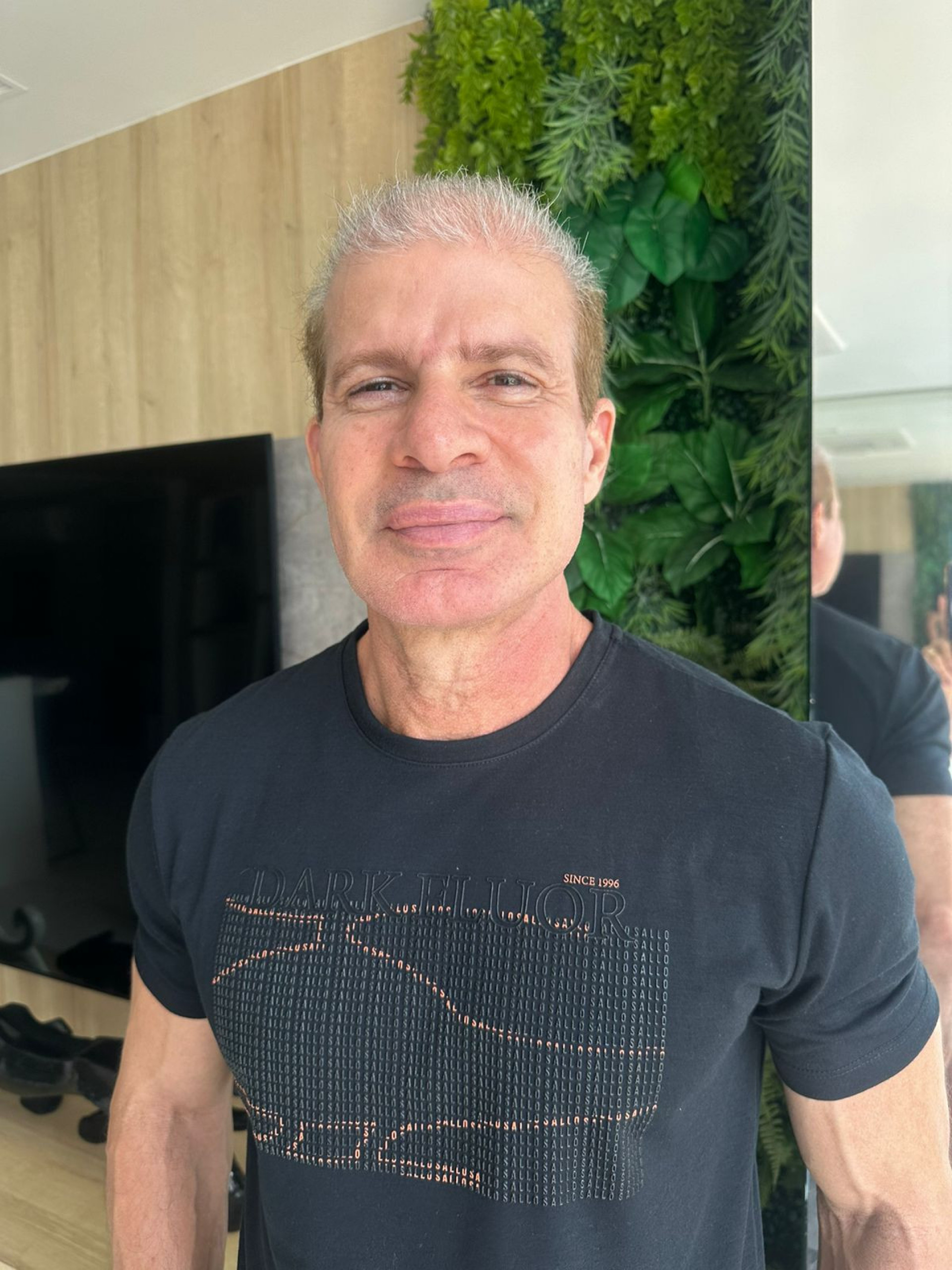 Túlio Maravilha fez procedimento de implante capilar