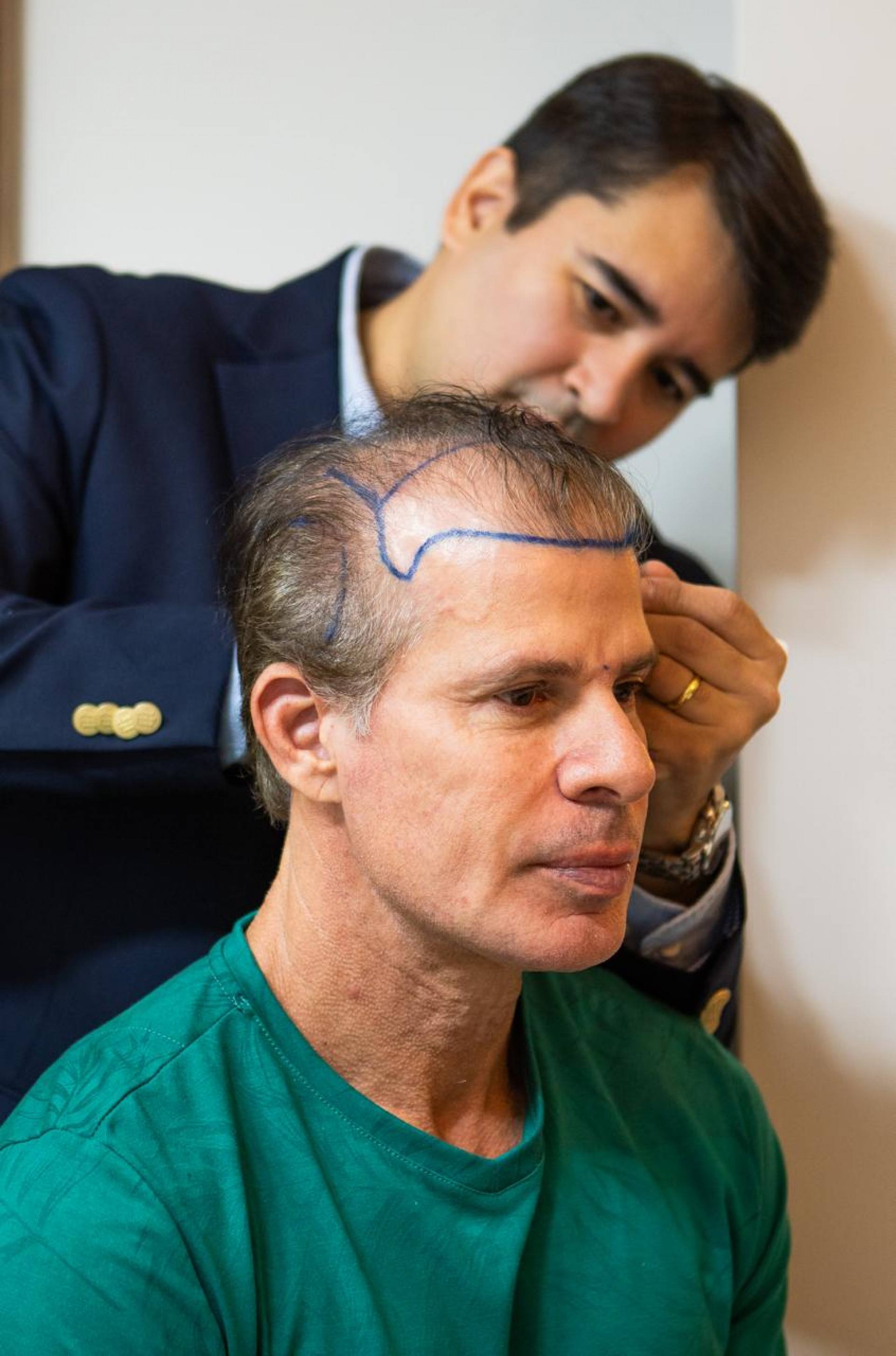 Túlio Maravilha fez procedimento de implante capilar