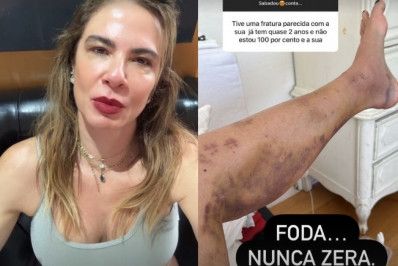 Mais de um ano após acidente, Luciana Gimenez exibe hematomas na perna