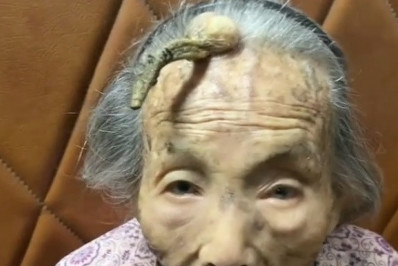Doença obriga chinesa de 107 anos a conviver com 'chifre' na testa