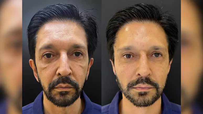 Ricardo Nunes realiza harmonização facial e fotos viralizam; veja antes e depois