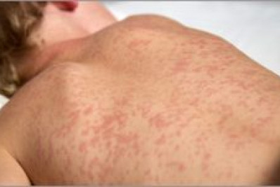 Vacinas contra o sarampo salvam cinco vidas por segundo, diz OMS