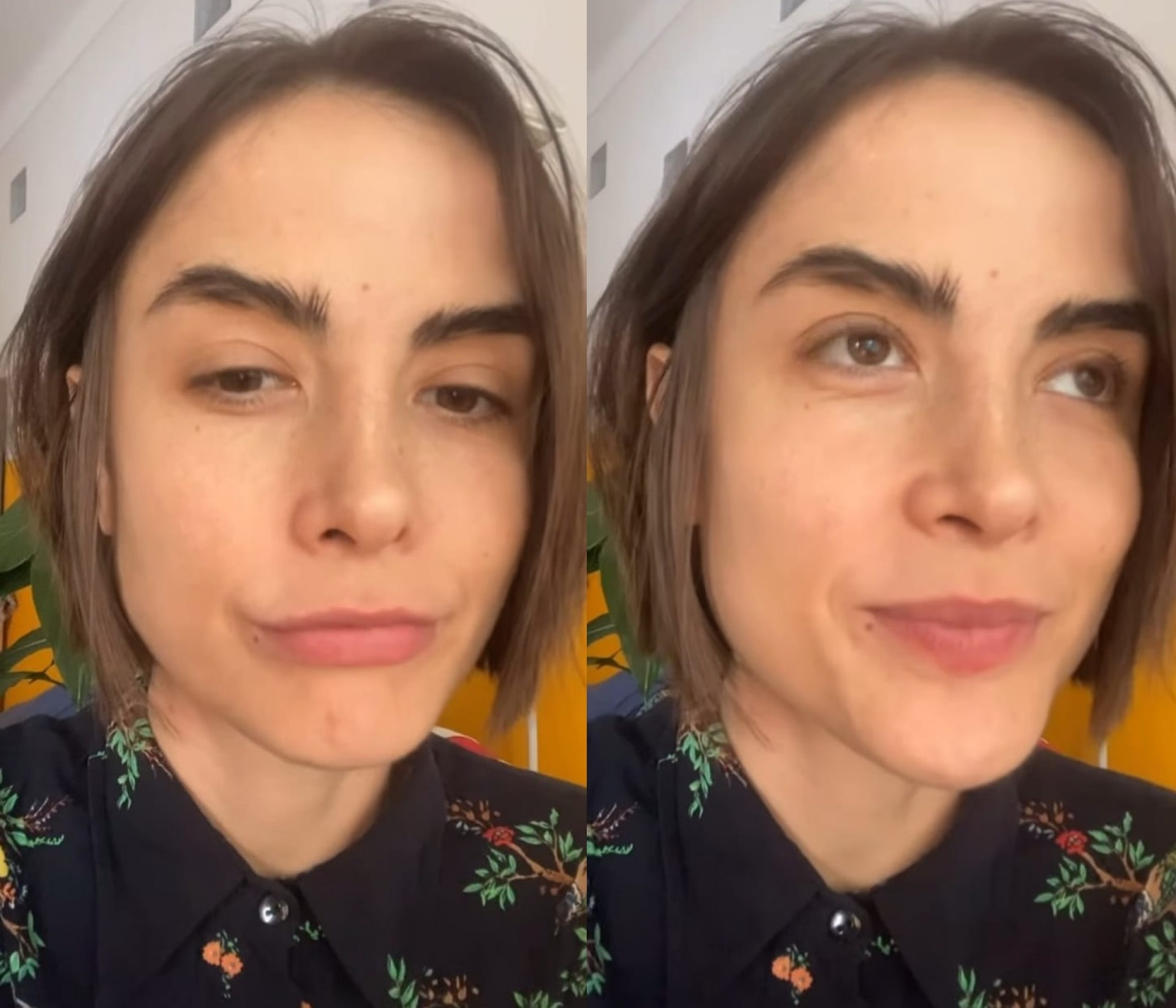 Atriz passou por cirurgia após descoberta de síndrome rara - Reprodução/Instagram 