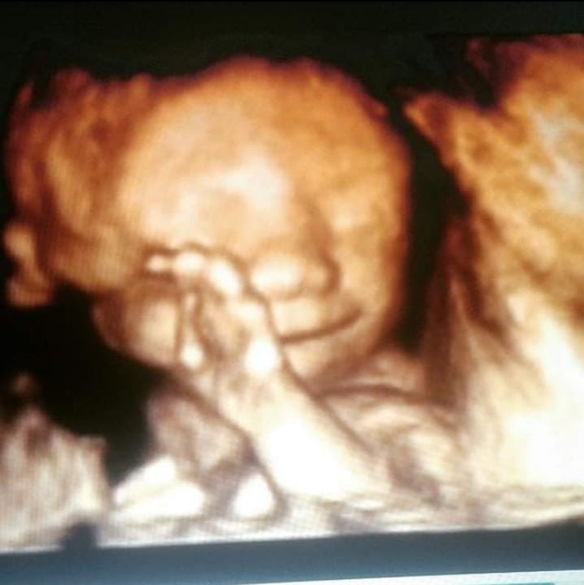 Segundo a mãe, a bebezinha sempre sorria durante os exames de imagem - Divulgação