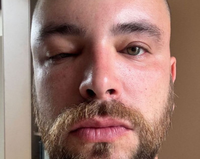 Ex-BBB Gustavo Marsengo mostra rosto inchado após cirurgia de transplante capilar