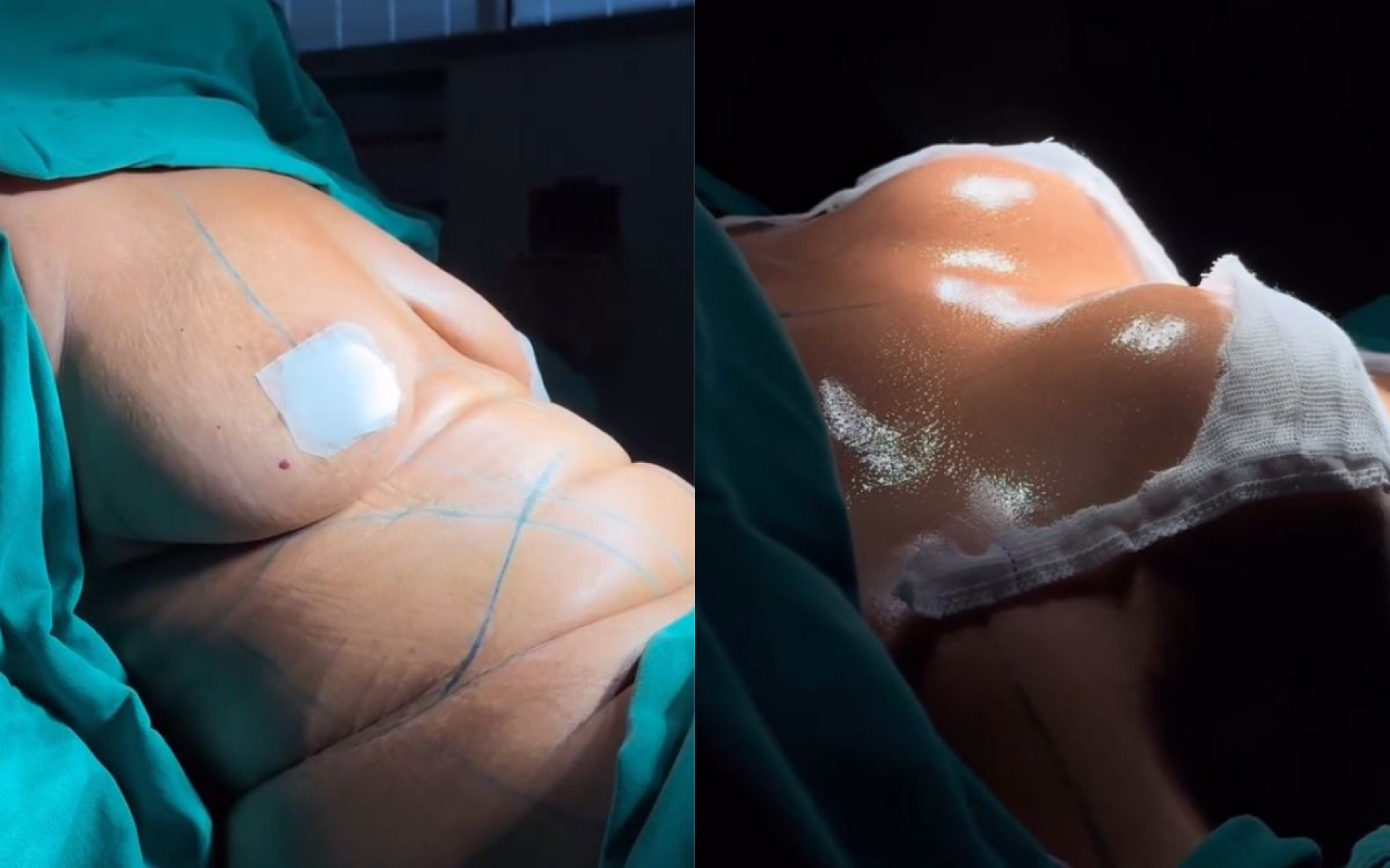 Mani Rego mostra antes e depois de corpo após passar por cirurgia plástica - Reprodução / Instagram