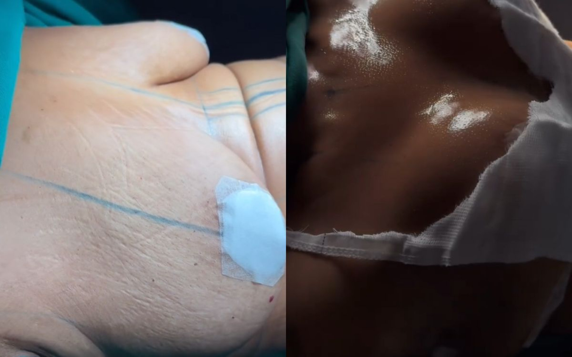 Mani Rego mostra antes e depois de corpo após passar por cirurgia plástica - Reprodução / Instagram