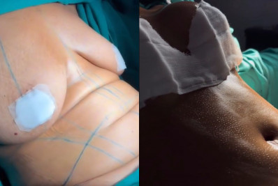 Ex de Davi Brito, Mani Rego impressiona ao mostrar antes e depois de cirurgia plástica