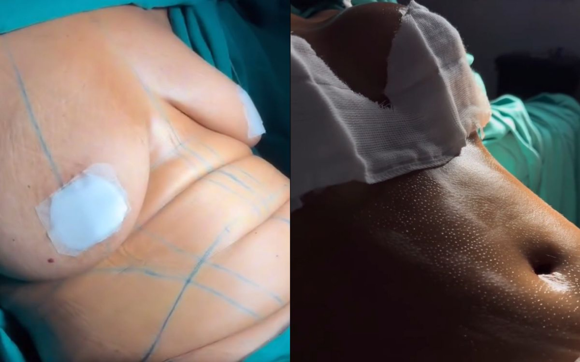Mani Rego mostra antes e depois de corpo após passar por cirurgia plástica - Reprodução / Instagram