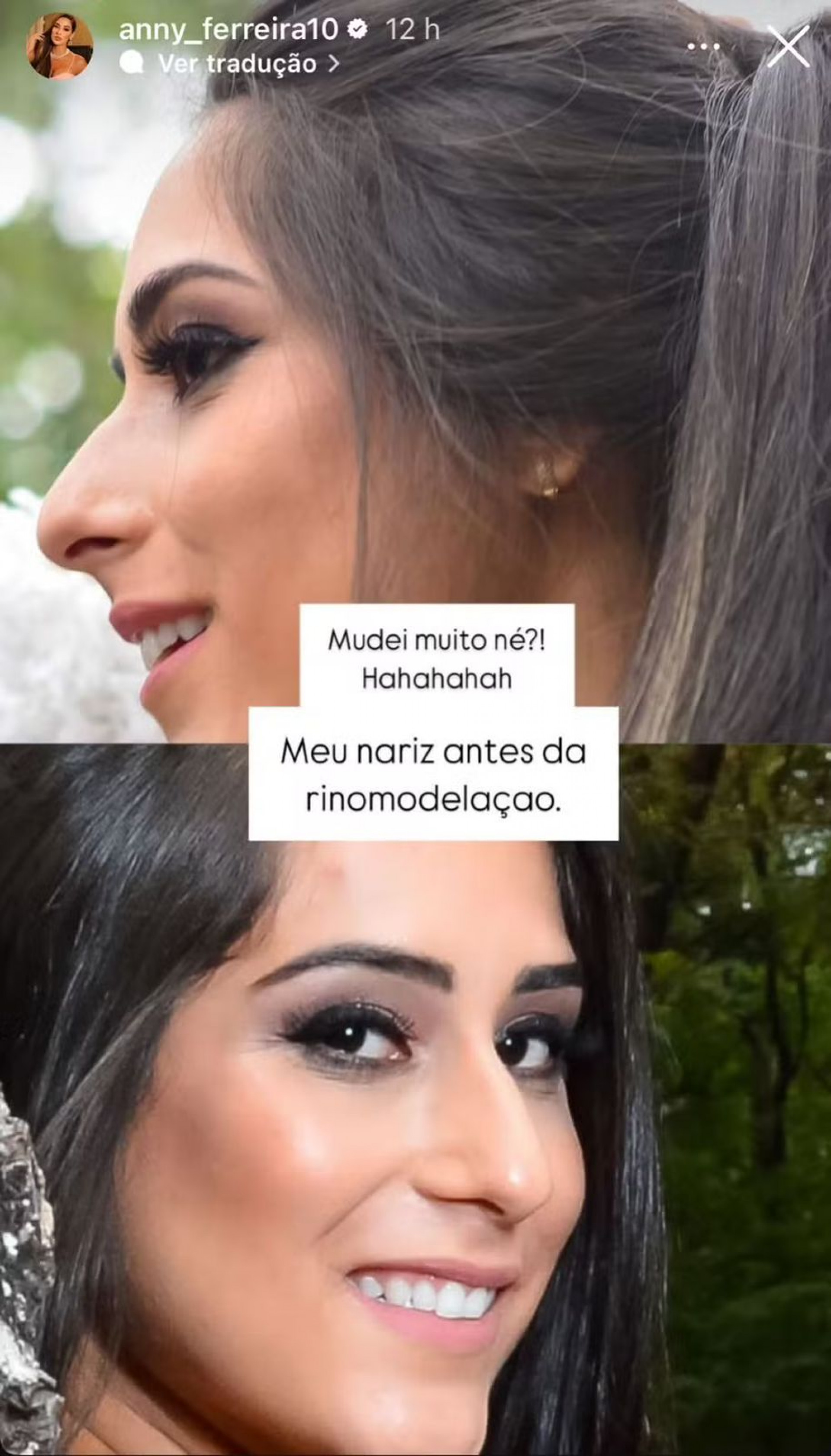 Deniziane Ferreira antes da rinomodelação e rinoplastia  - Reprodução / Instagram 