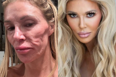 Ex-modelo internacional pede ajuda após rosto 'derreter': 'O que está acontecendo?'