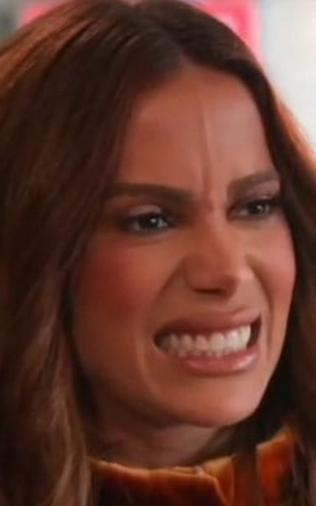 Anitta realiza procedimento estético para remoção de veia na testa - Reprodução / Internet 