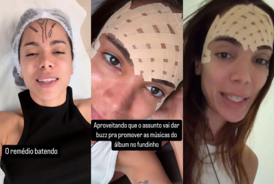 Anitta realiza procedimento estético na testa: 'Veia se foi'