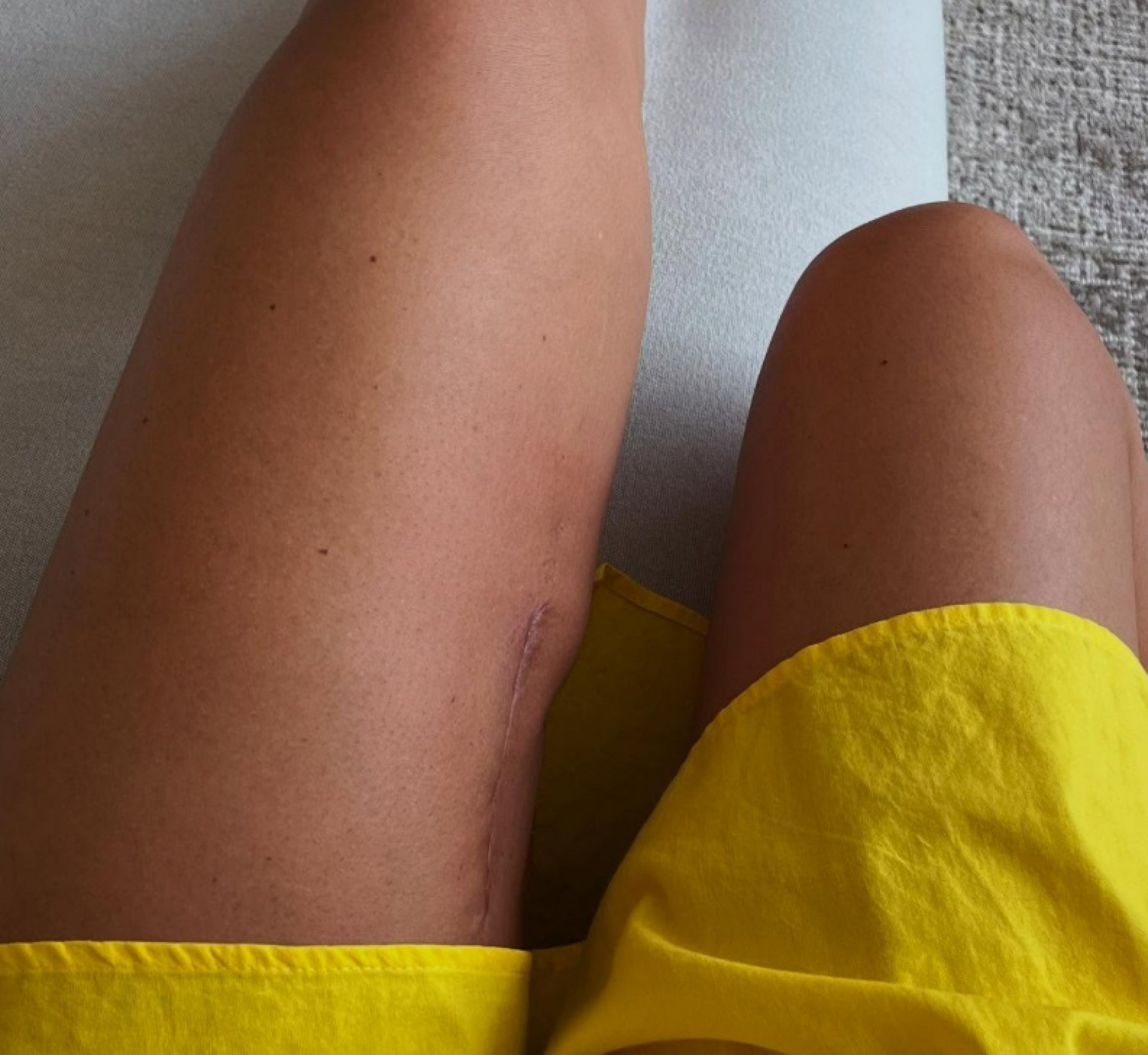 Vera Viel exibe cicatriz na coxa - Reprodução do Instagram