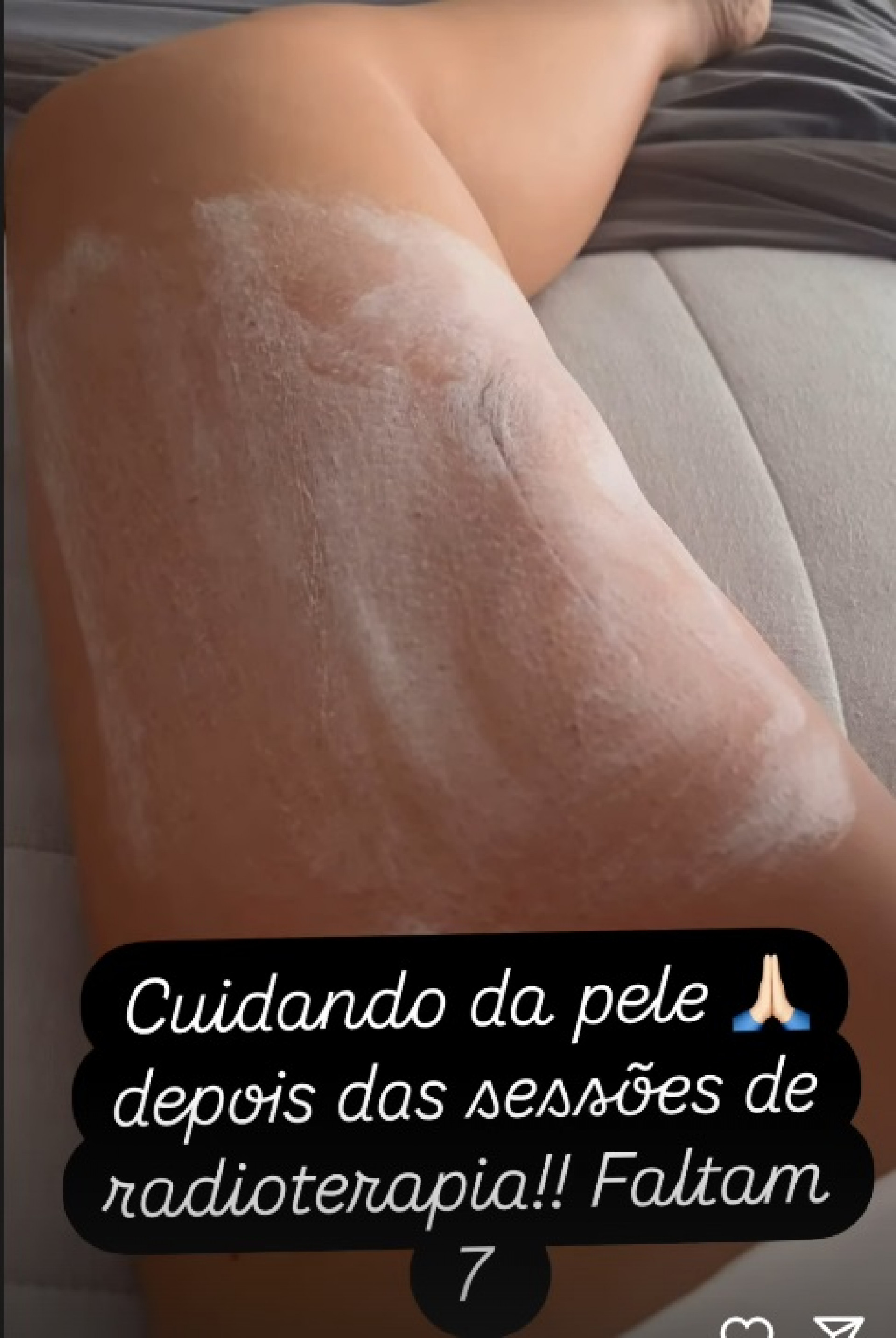Vera Viel mostra reação da radioterapia - Reprodução do Instagram