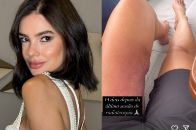 Vera Viel exibe cicatriz após término das sessões de radioterapia