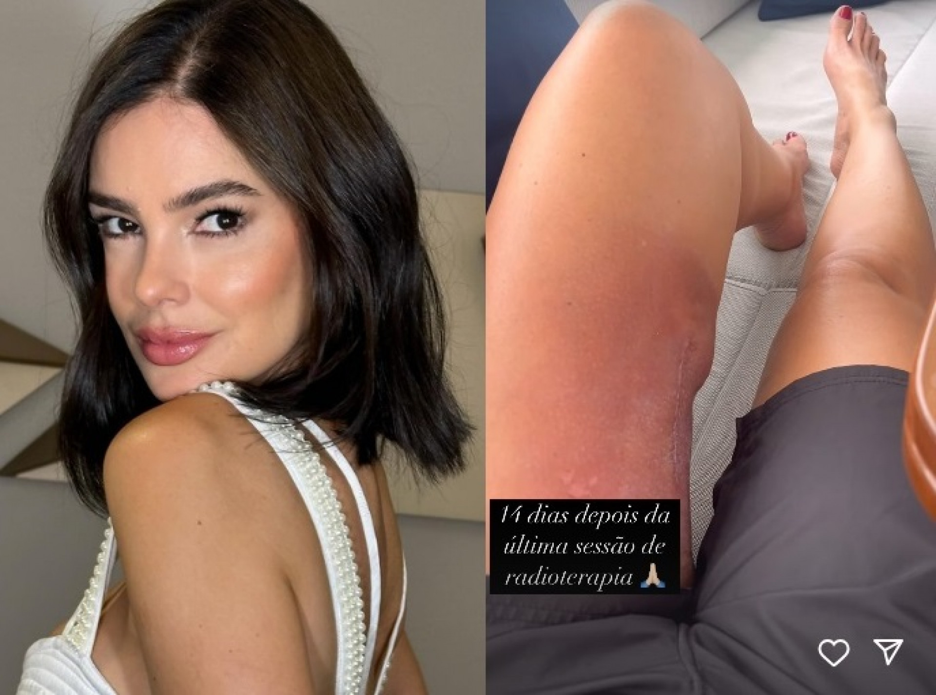 Vera Viel mostrou cicatriz duas semanas após fim da radioterapia  - Reprodução/Instagram 