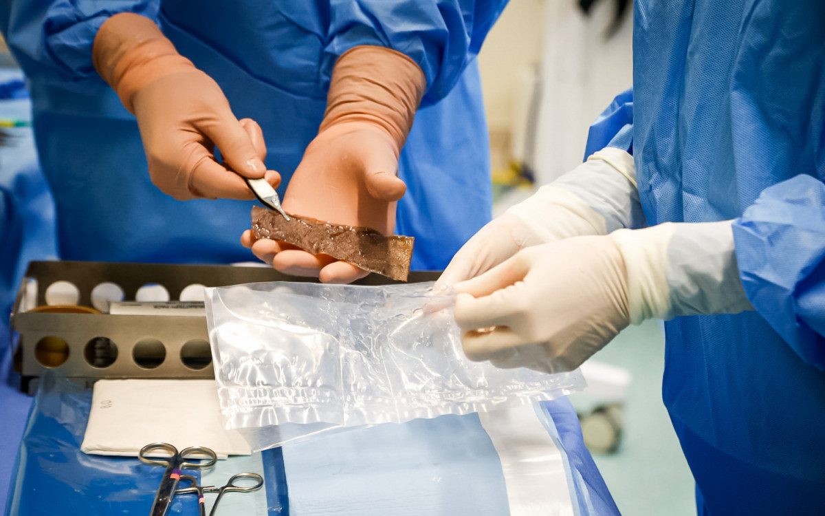 O transplante é solução temporária para estabilizar as lesões até que enxertos definitivos sejam implantados