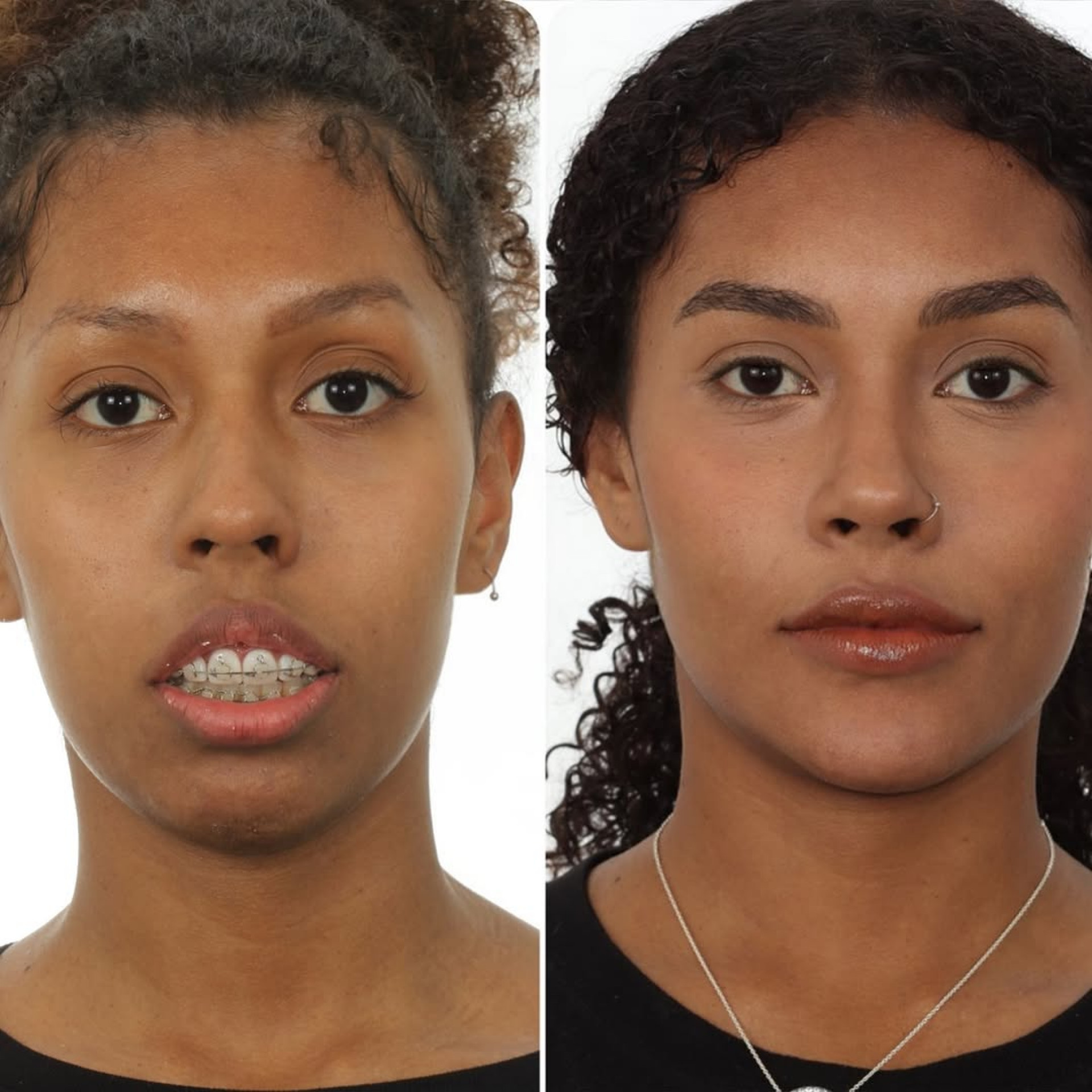 Antes e depois da cirurgia ortognática de Giovanna Jacobina  - Reprodução / Instagram 