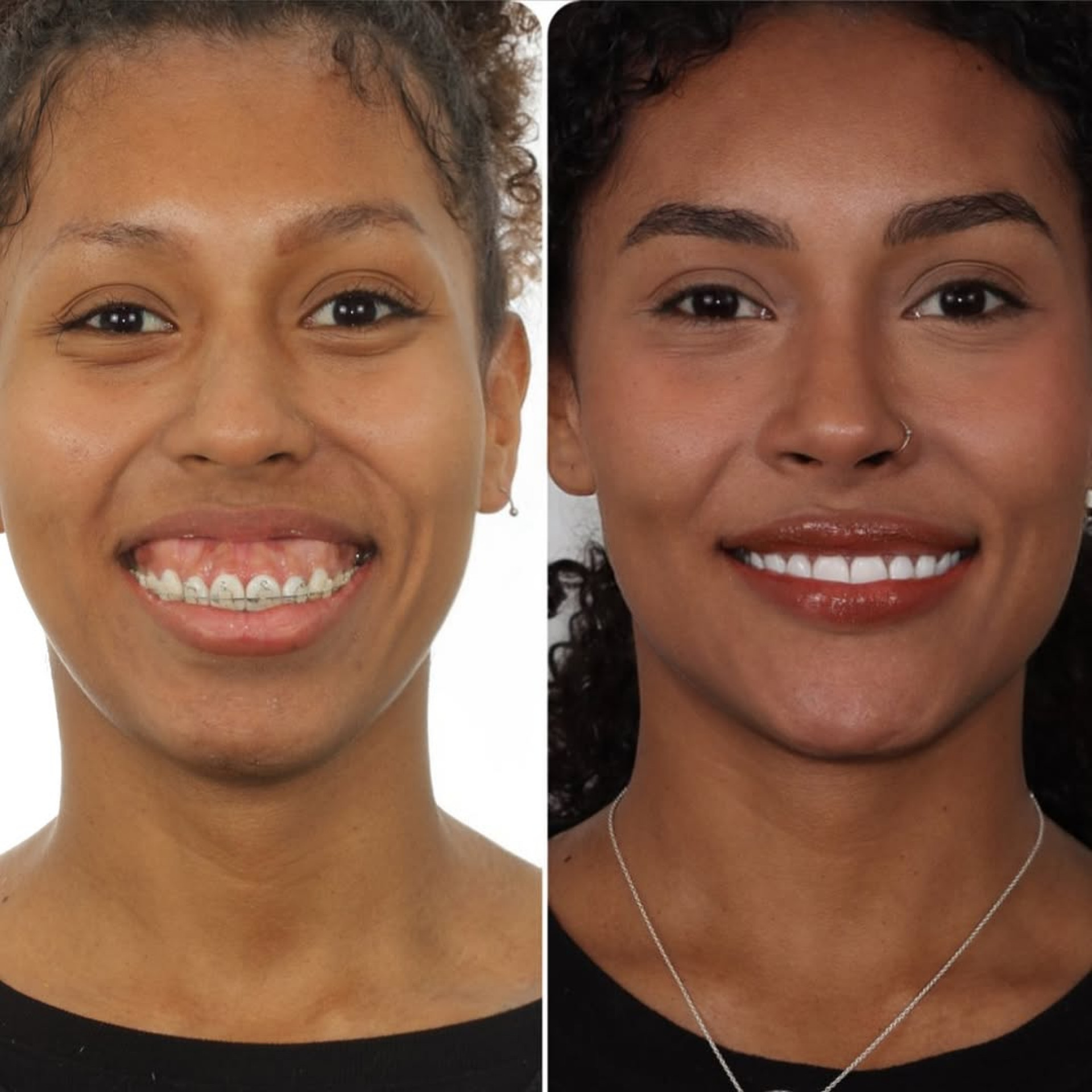 Antes e depois da cirurgia ortognática de Giovanna Jacobina  - Reprodução / Instagram 