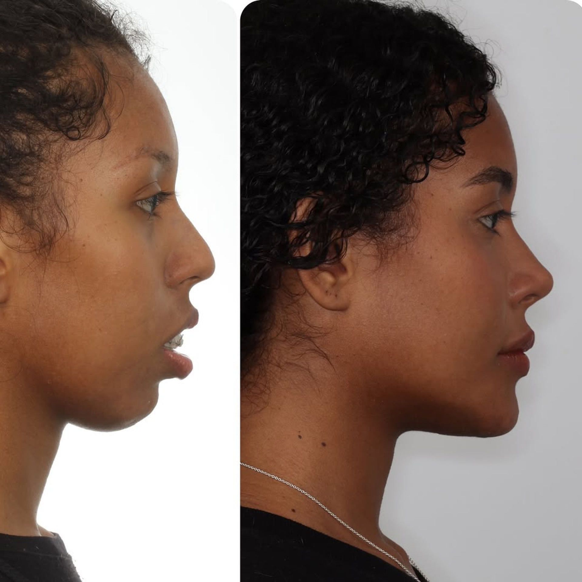 Antes e depois da cirurgia ortognática de Giovanna Jacobina  - Reprodução / Instagram 