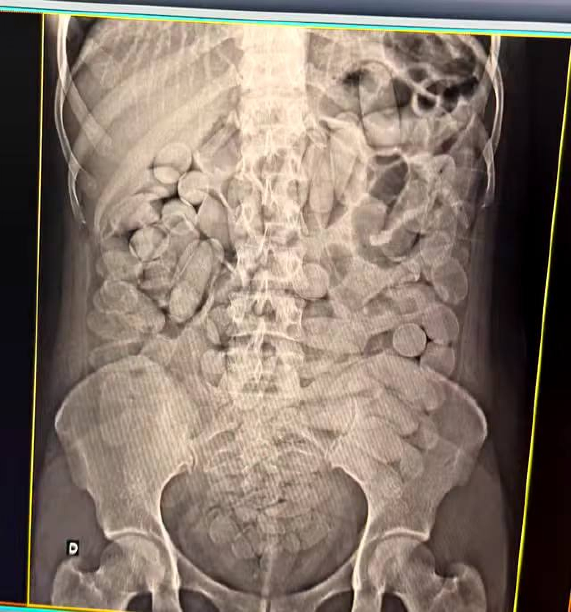 Mulheres engoliram diversas cápsulas e foram encaminhadas ao hospital  - Divulgação/Receita Federal