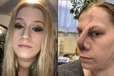 Imagem forte! Médicos usam couro cabeludo para reconstruir nariz de mulher viciada em cocaína