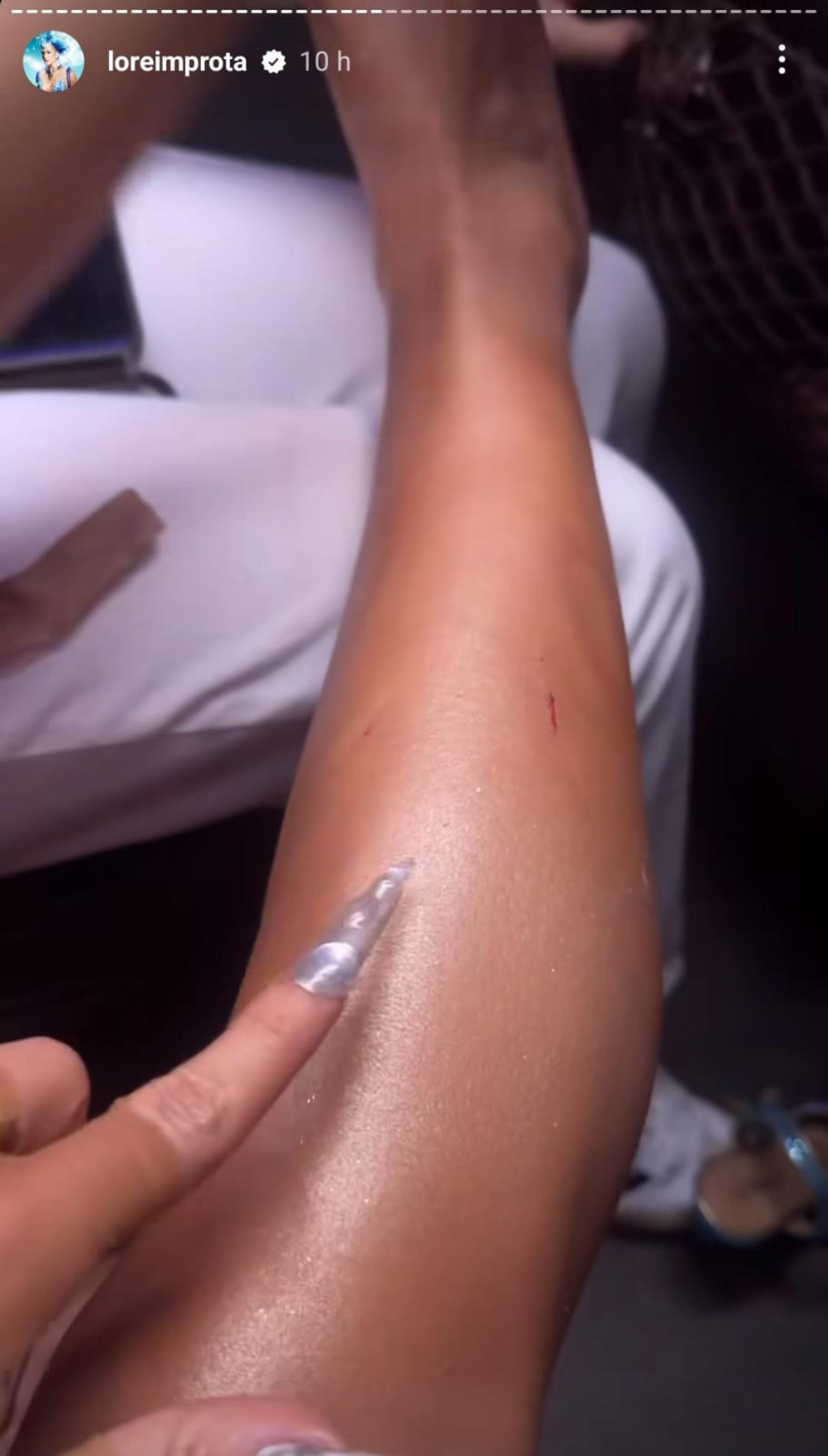Lore Improta mostra cortes na coxa e bumbum após tombo na Sapucaí: 'Primeira queda' - Reprodução de vídeo / Instagram