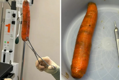 EUA: homem é submetido a cirurgia para remover cenoura de 20 cm do ânus