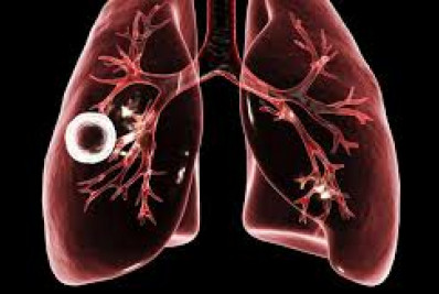 São Gonçalo faz ação para alertar sobre tuberculose nesta terça-feira