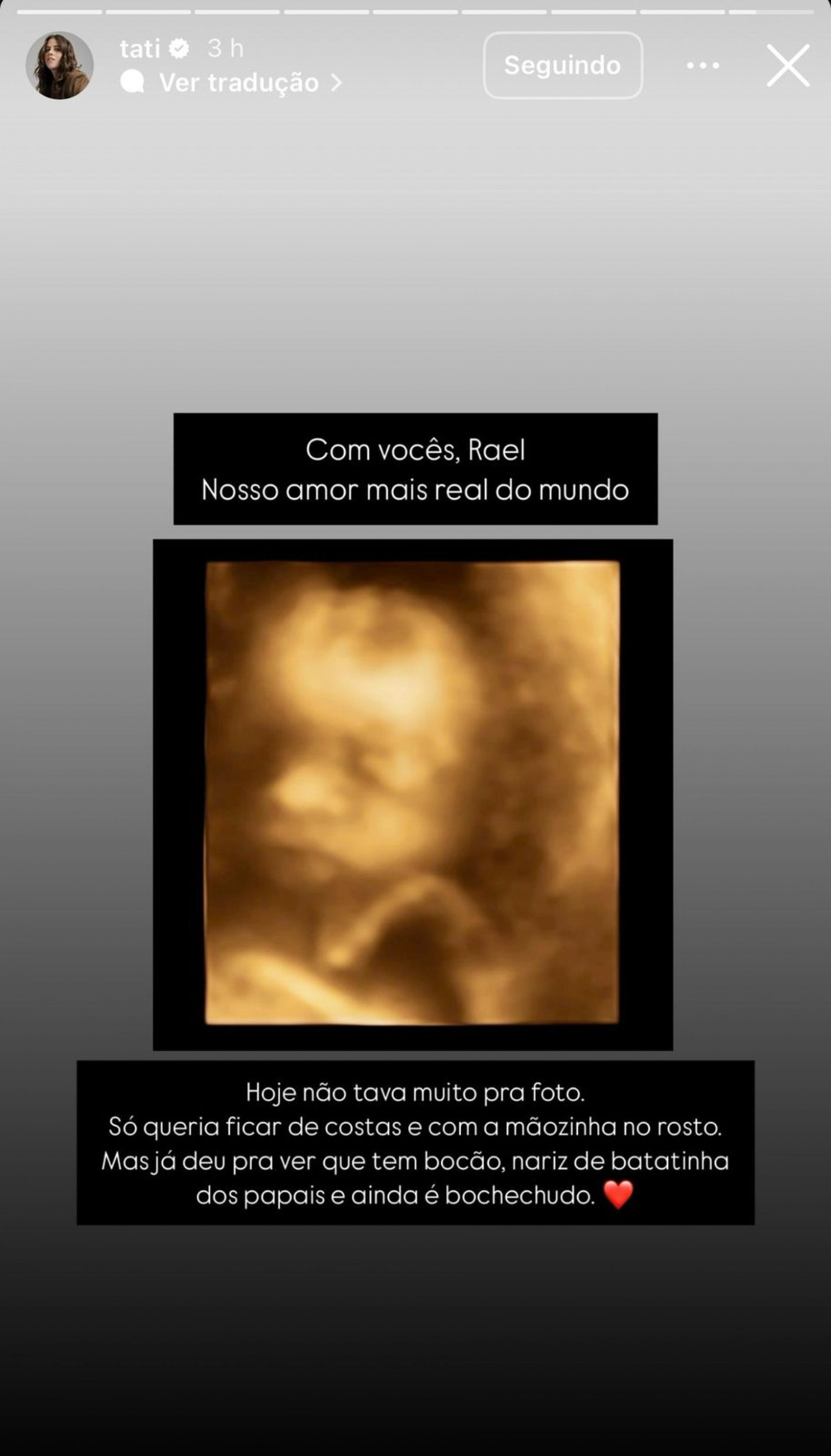 Rosto do filho de Tati Machado no exame de ultrassom - Reprodução/Instagram