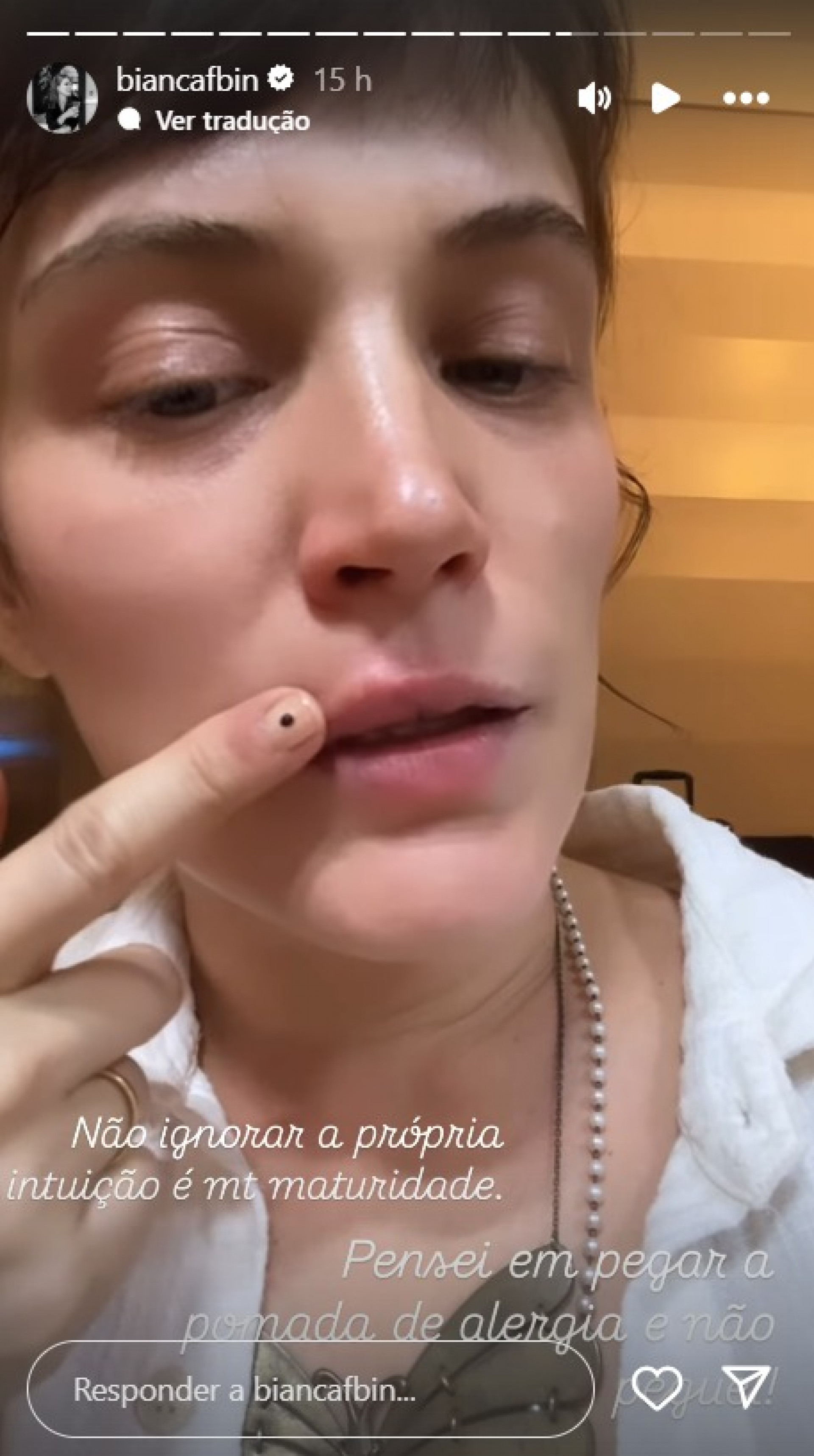 Bianca Bin mostra lábios após ter reação alérgica  - Reprodução Instagram